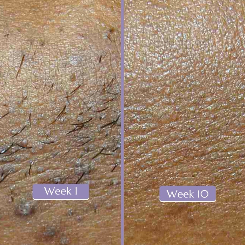Serenity IPL Hair Removal Handset