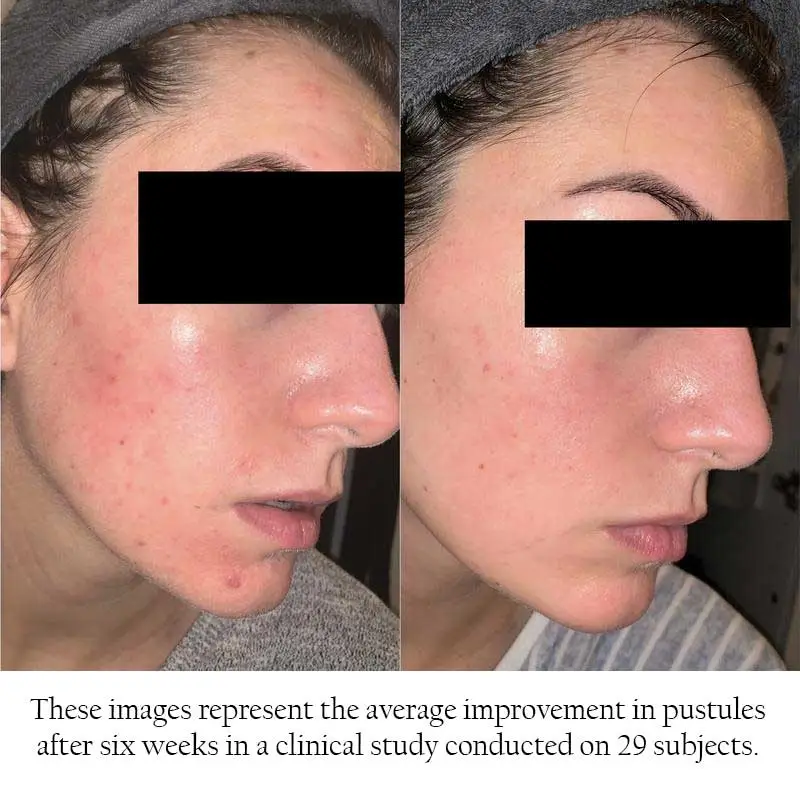 The Ordinary Retinol Serum 0.2% in Squalene